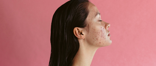 Une femme ayant beaucoup d’acné sur la peau